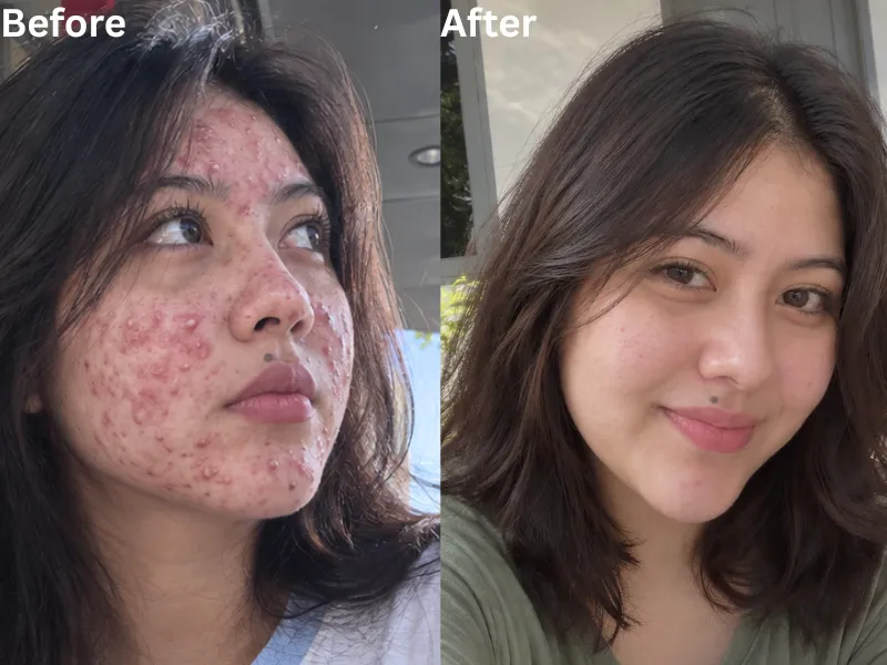 Foto before dan after pengalaman kulit